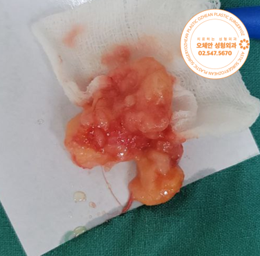 등 혹 3~4cm 지방종, 어느 병원에서 수술해야 할까?