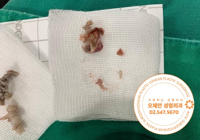 표피낭종 병원 선택하는 기준은?