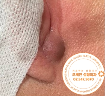 귀 종양 고름이 생기기 전에 제거하셔야 합니다!