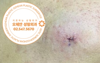 얼굴 딱딱한 멍울 자꾸 재발해요