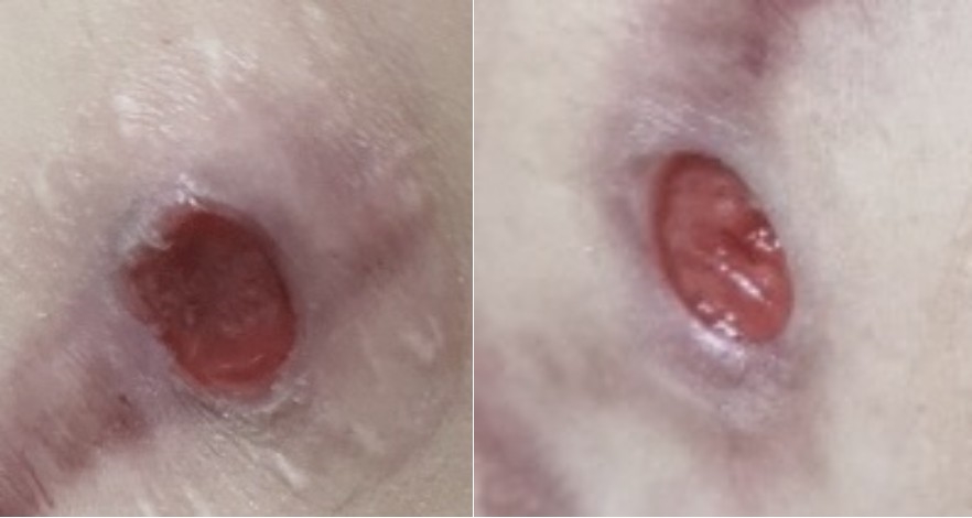 까진 상처 상처 치료를 성형외과에서 받아야 하는 이유