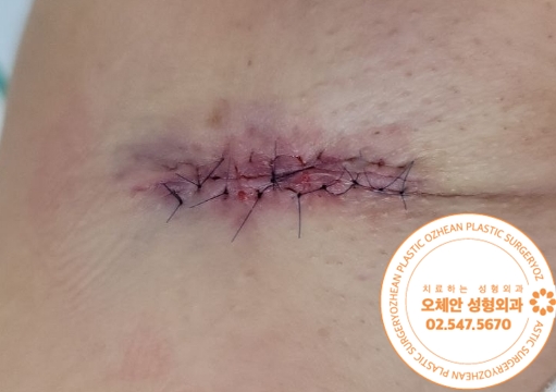 겨드랑이 고름 표피낭종 오래 방치하지마세요.