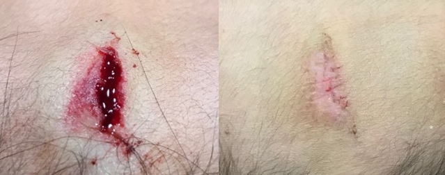 상처봉합, 일차봉합 - 성형외과에서도 ...
